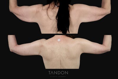 Arm Lift (Brachioplasty) Before & After Gallery - Patient 340609 - Image 2