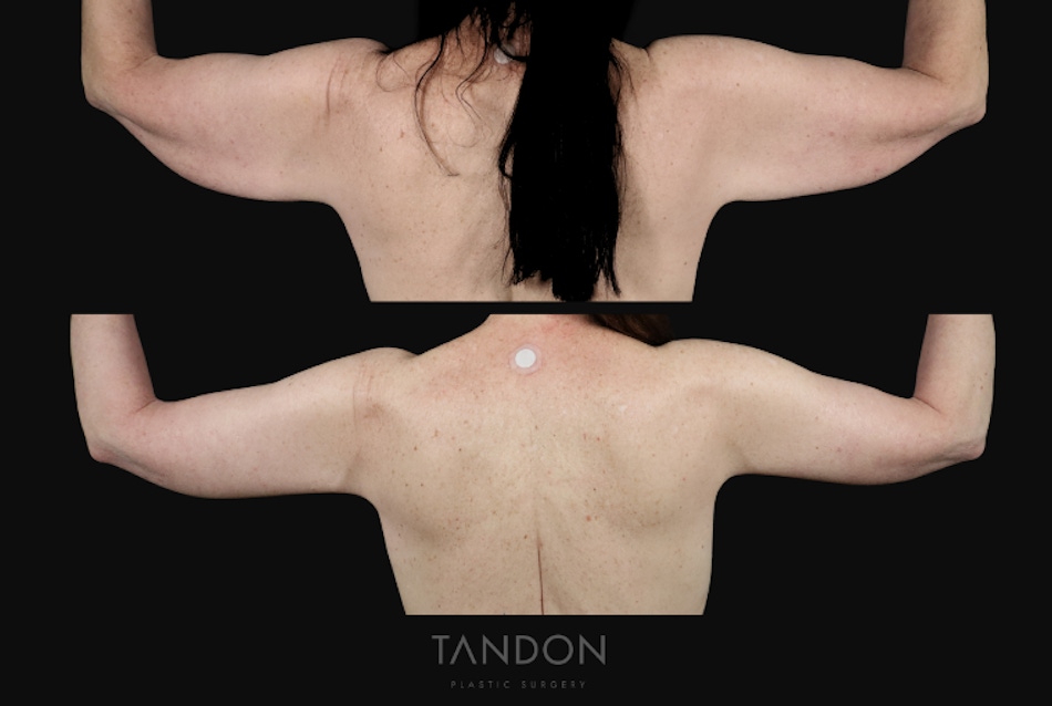 Arm Lift (Brachioplasty) Before & After Gallery - Patient 340609 - Image 2