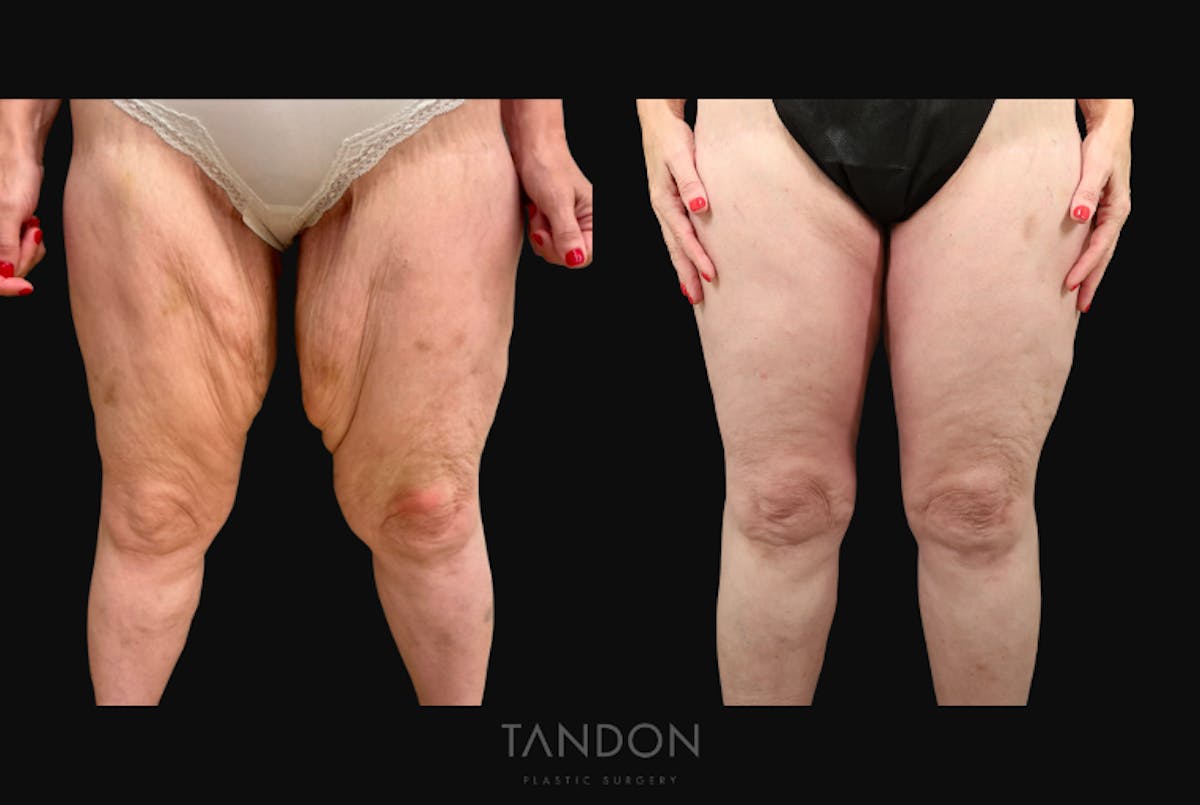 Thigh Lift Before & After Gallery - Patient 195340 - Image 1