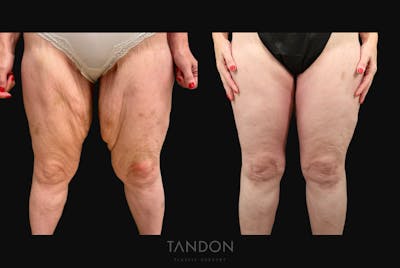 Thigh Lift Before & After Gallery - Patient 195340 - Image 1