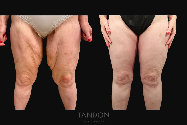 Thigh Lift Before & After Gallery - Patient 195340 - Image 1