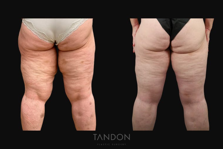 Thigh Lift Before & After Gallery - Patient 195340 - Image 2
