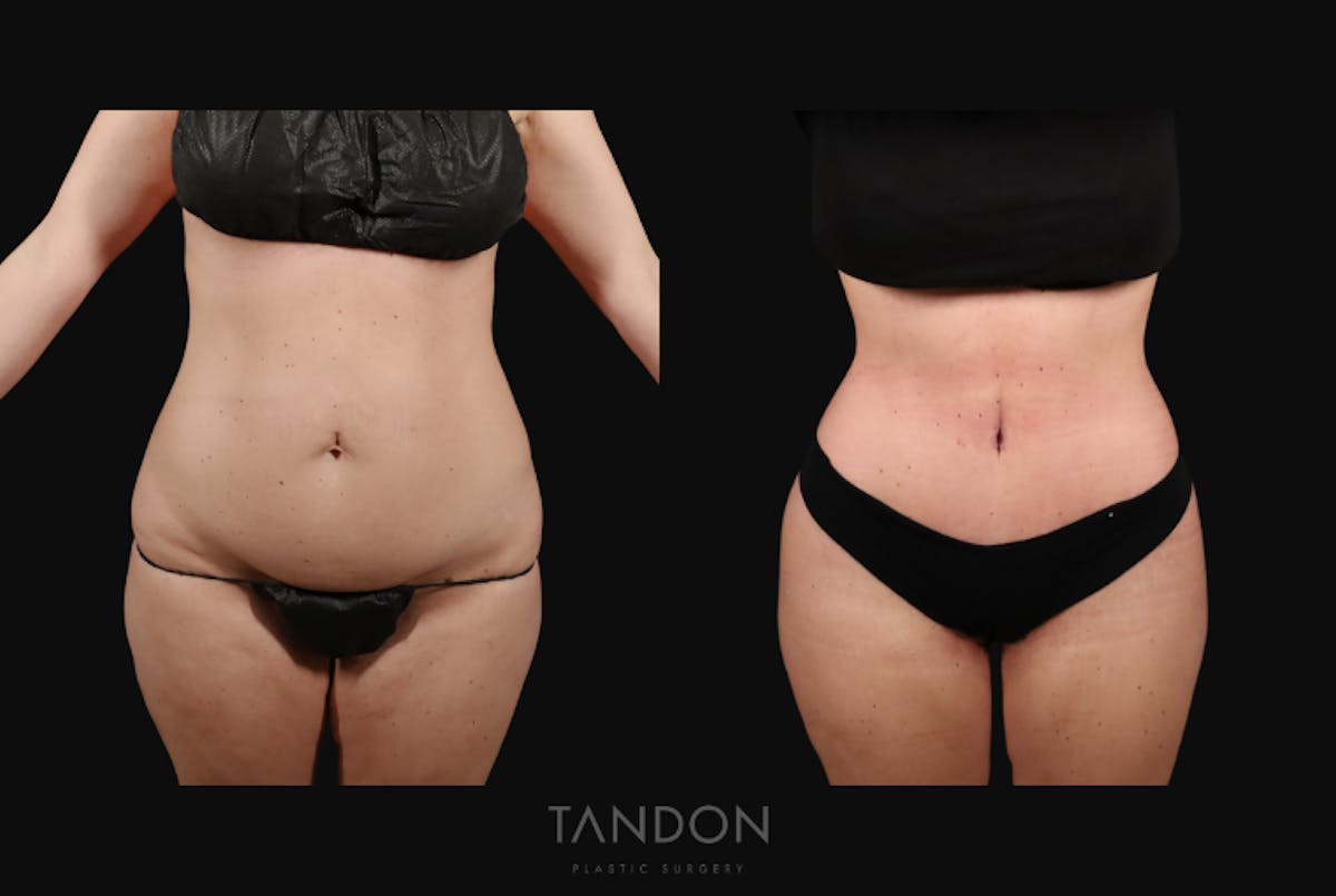Thigh Lift Before & After Gallery - Patient 163218 - Image 1