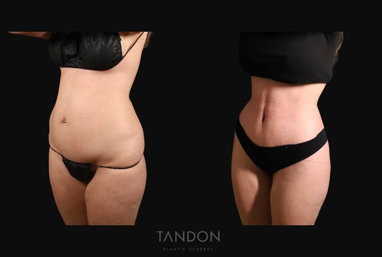 Thigh Lift Before & After Gallery - Patient 163218 - Image 4