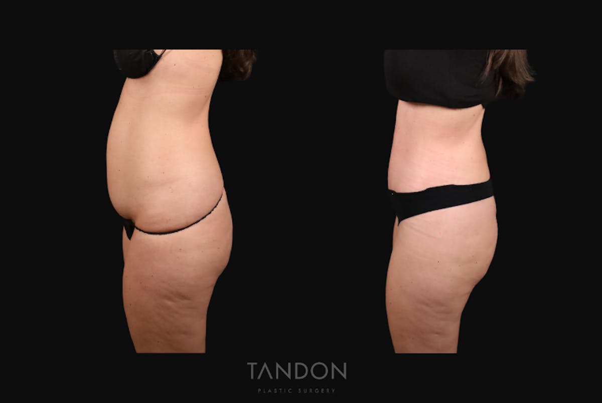 Thigh Lift Before & After Gallery - Patient 163218 - Image 5