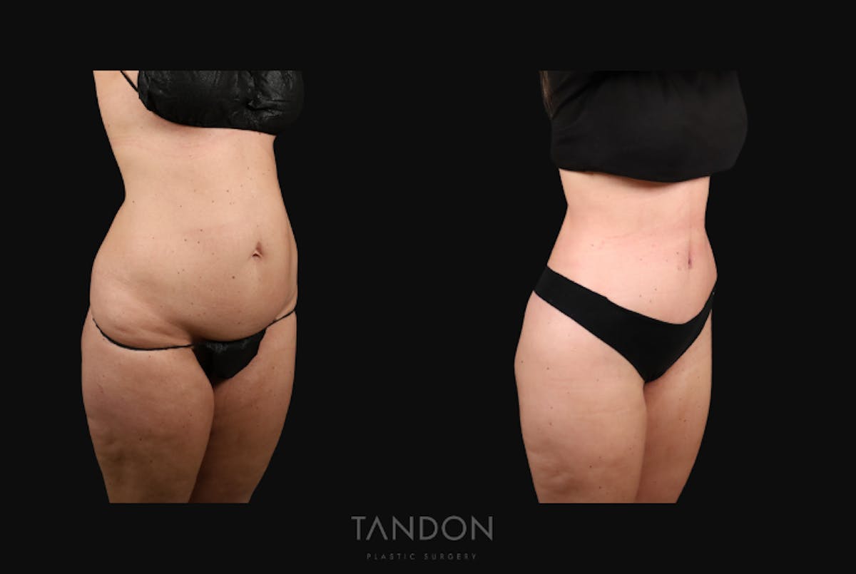 Thigh Lift Before & After Gallery - Patient 163218 - Image 3