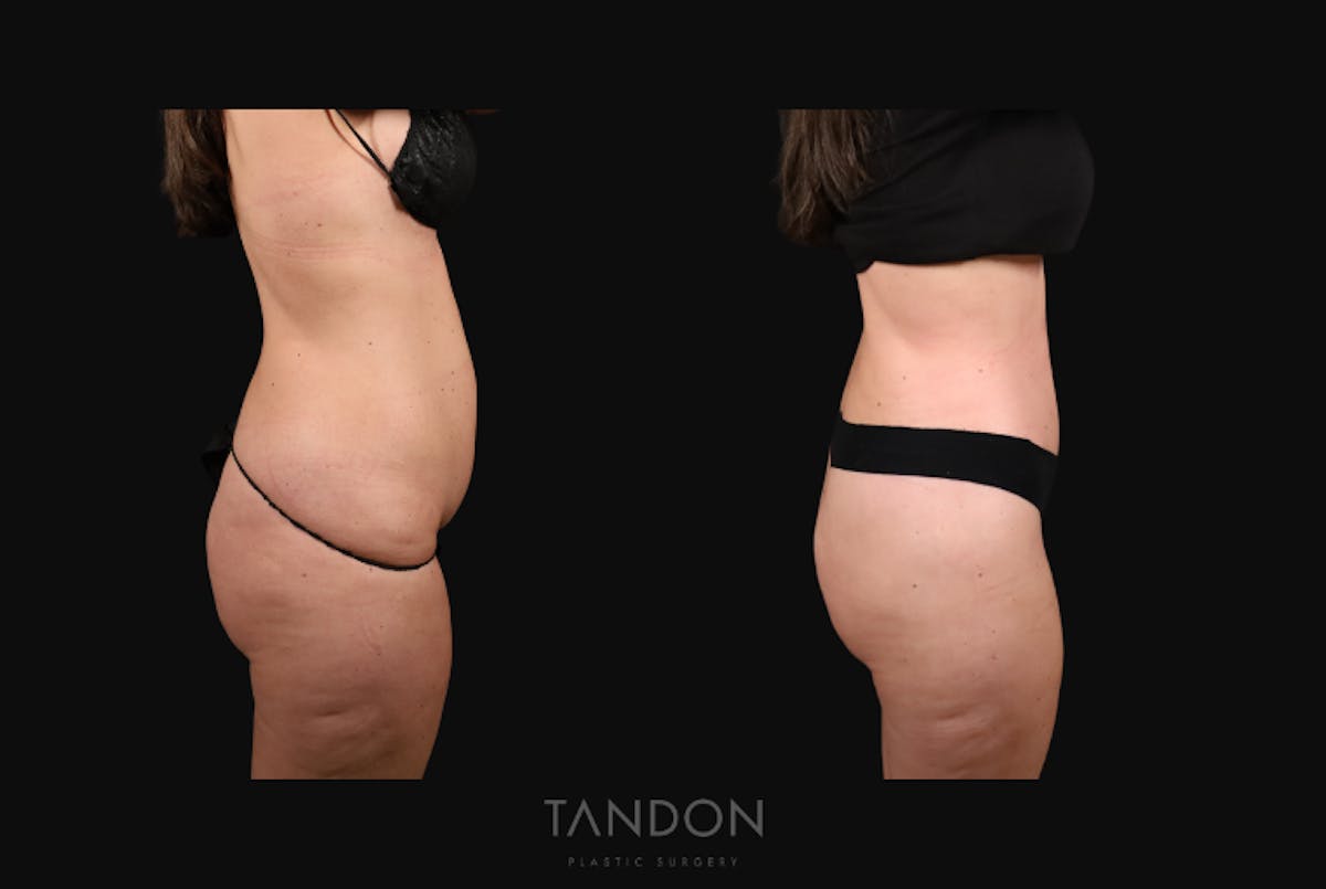 Thigh Lift Before & After Gallery - Patient 163218 - Image 6