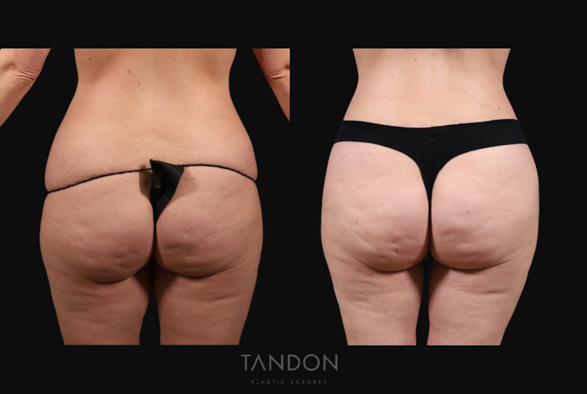 Thigh Lift Before & After Gallery - Patient 163218 - Image 2
