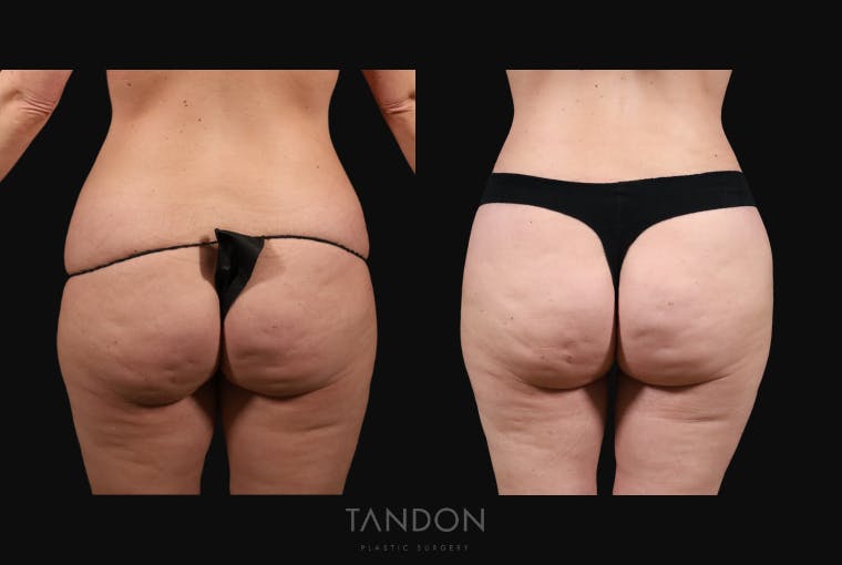 Thigh Lift Before & After Gallery - Patient 163218 - Image 2