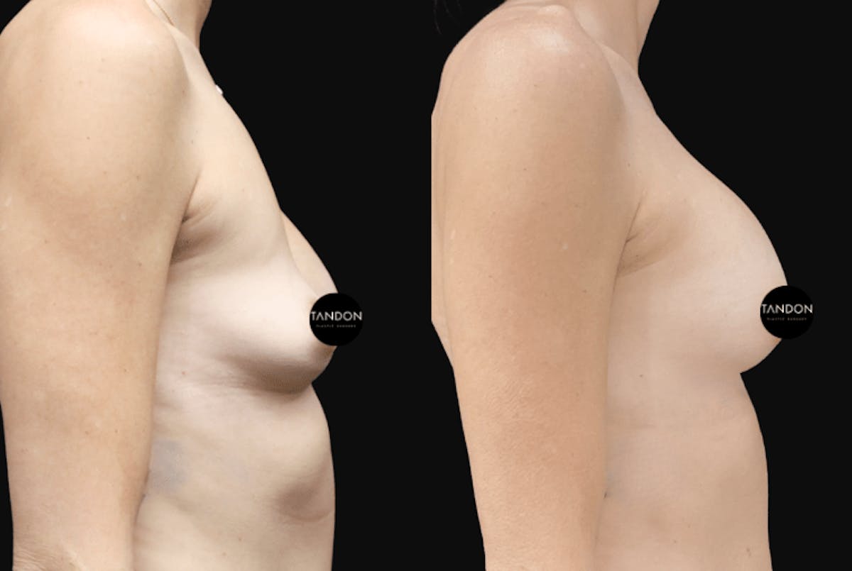 Breast Implant Exchange Before & After Gallery - Patient 242901 - Image 3