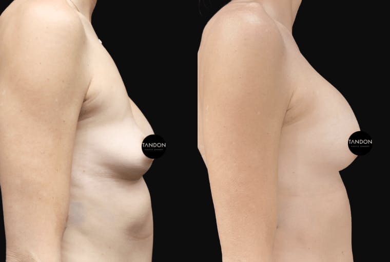 Breast Augmentation Before & After Gallery - Patient 306988 - Image 3