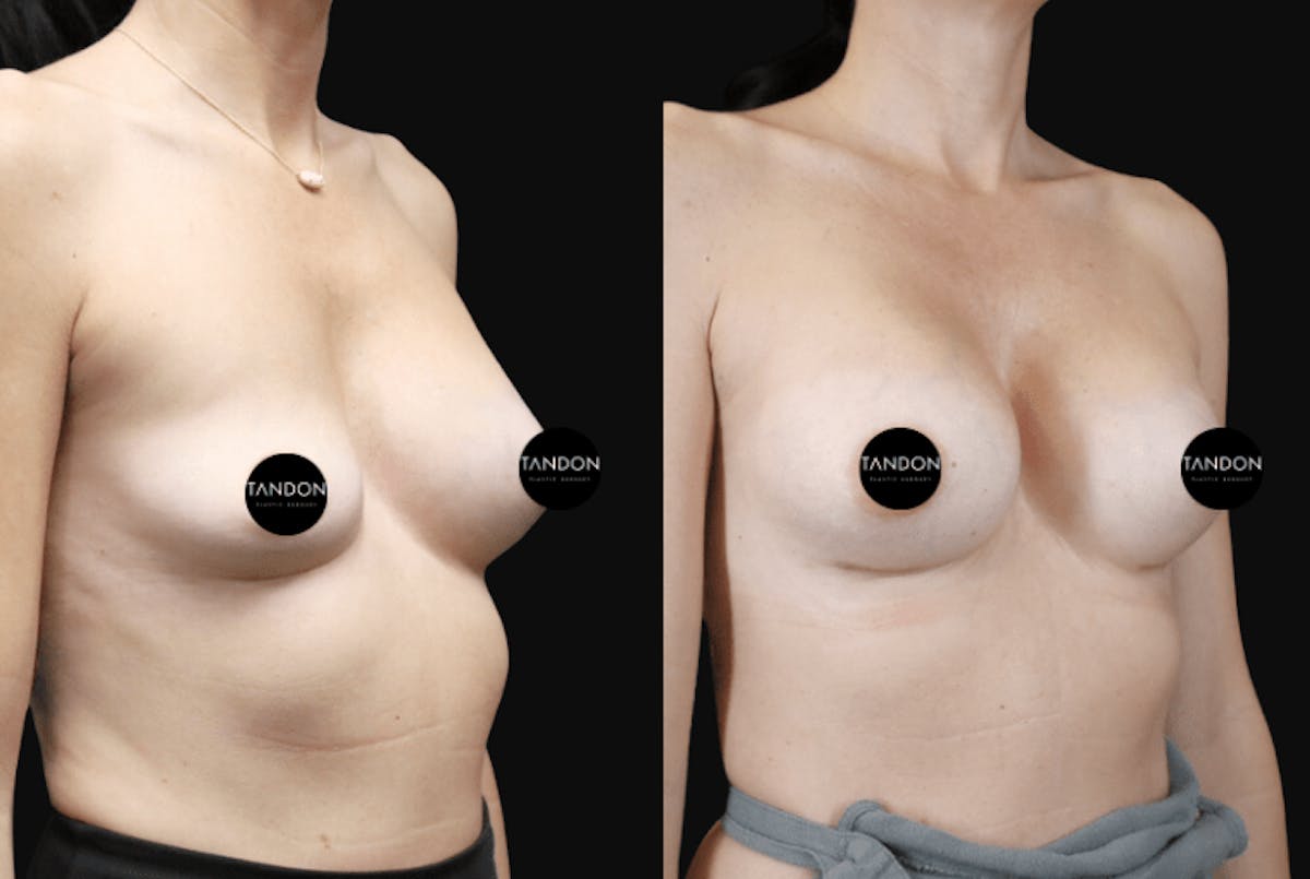 Breast Implant Exchange Before & After Gallery - Patient 242901 - Image 2