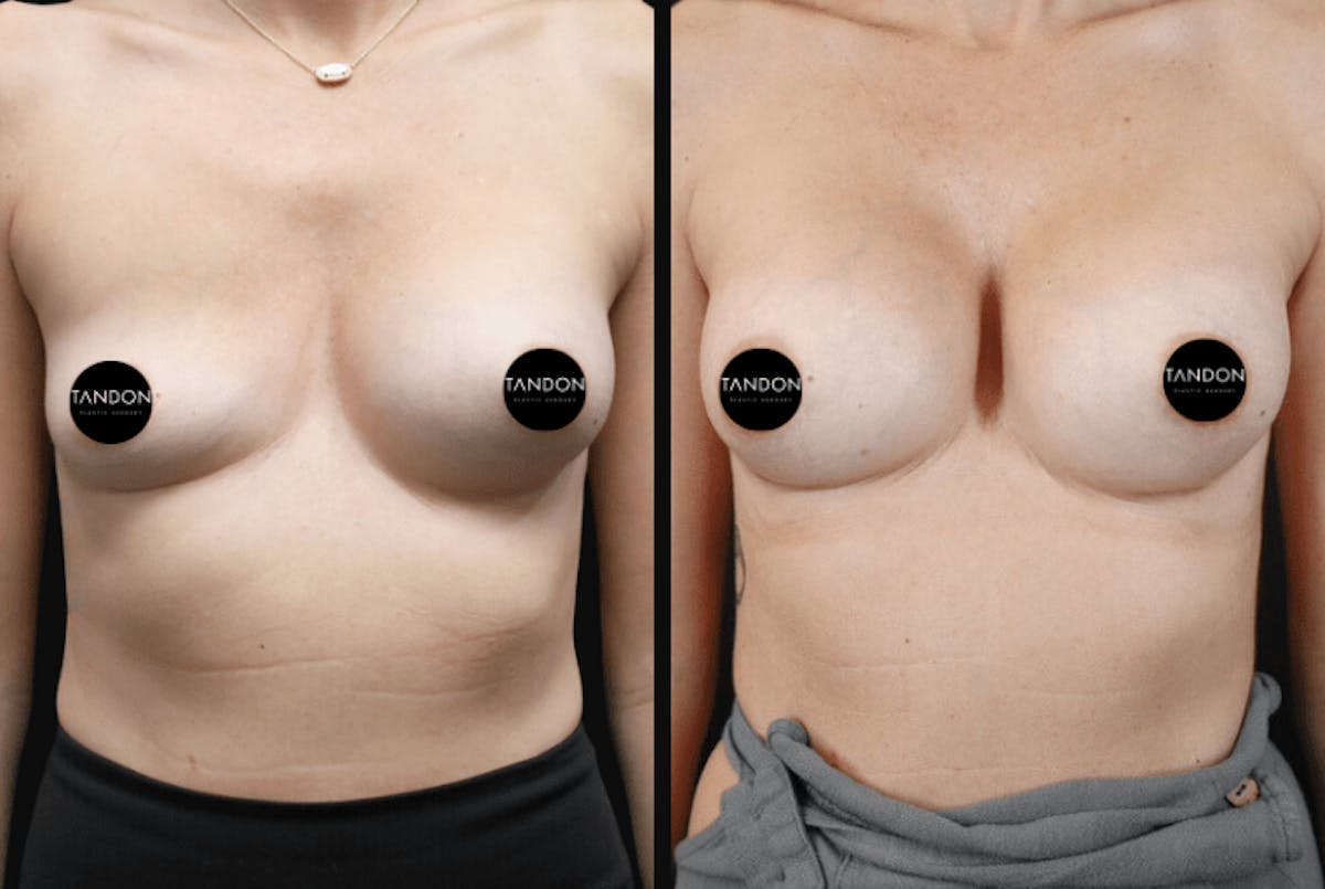 Breast Implant Exchange Before & After Gallery - Patient 242901 - Image 1