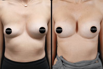Breast Augmentation Before & After Gallery - Patient 306988 - Image 1