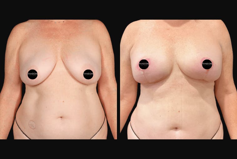 Breast Lift Before & After Gallery - Patient 257368 - Image 1