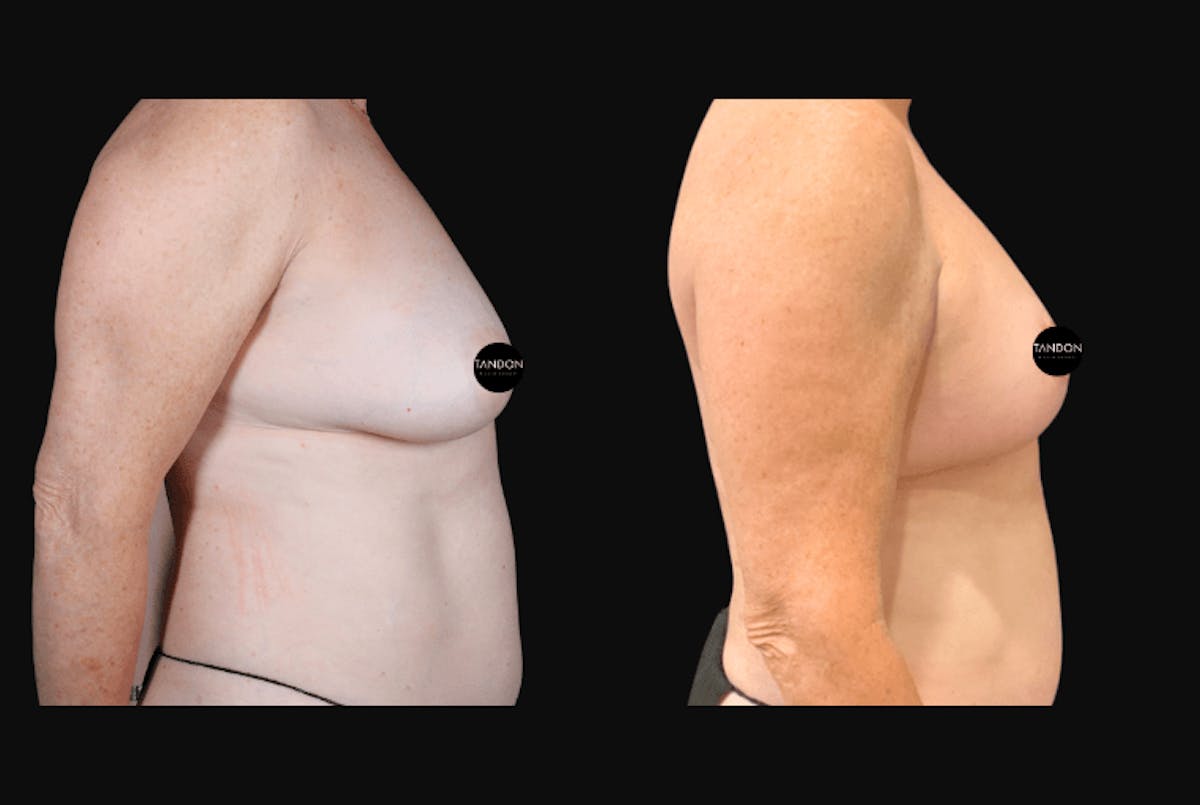 Breast Lift Before & After Gallery - Patient 257368 - Image 3