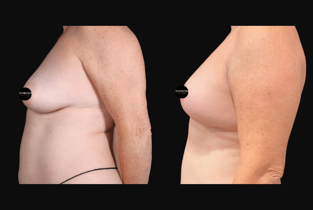 Breast Lift Before & After Gallery - Patient 257368 - Image 5