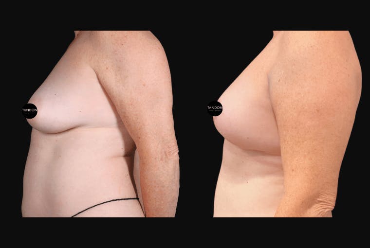 Breast Lift Before & After Gallery - Patient 257368 - Image 5