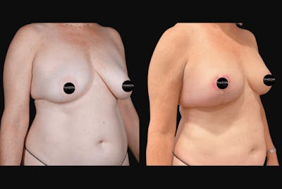 Breast Lift Before & After Gallery - Patient 257368 - Image 2
