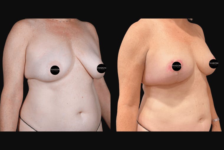 Breast Lift Before & After Gallery - Patient 257368 - Image 2