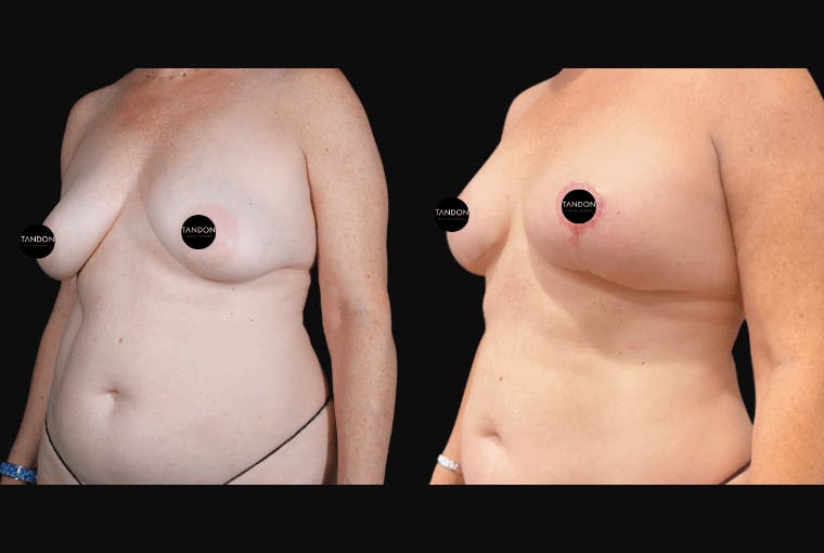 Breast Lift Before & After Gallery - Patient 257368 - Image 4