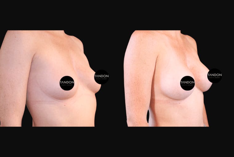 Breast Augmentation Before & After Gallery - Patient 318027 - Image 2