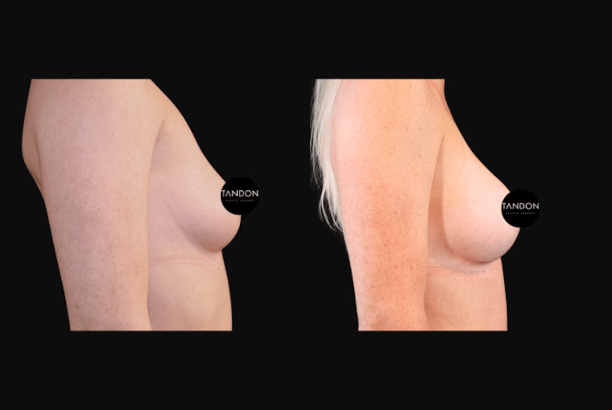 Breast Augmentation  Before & After Gallery - Patient 318027 - Image 3