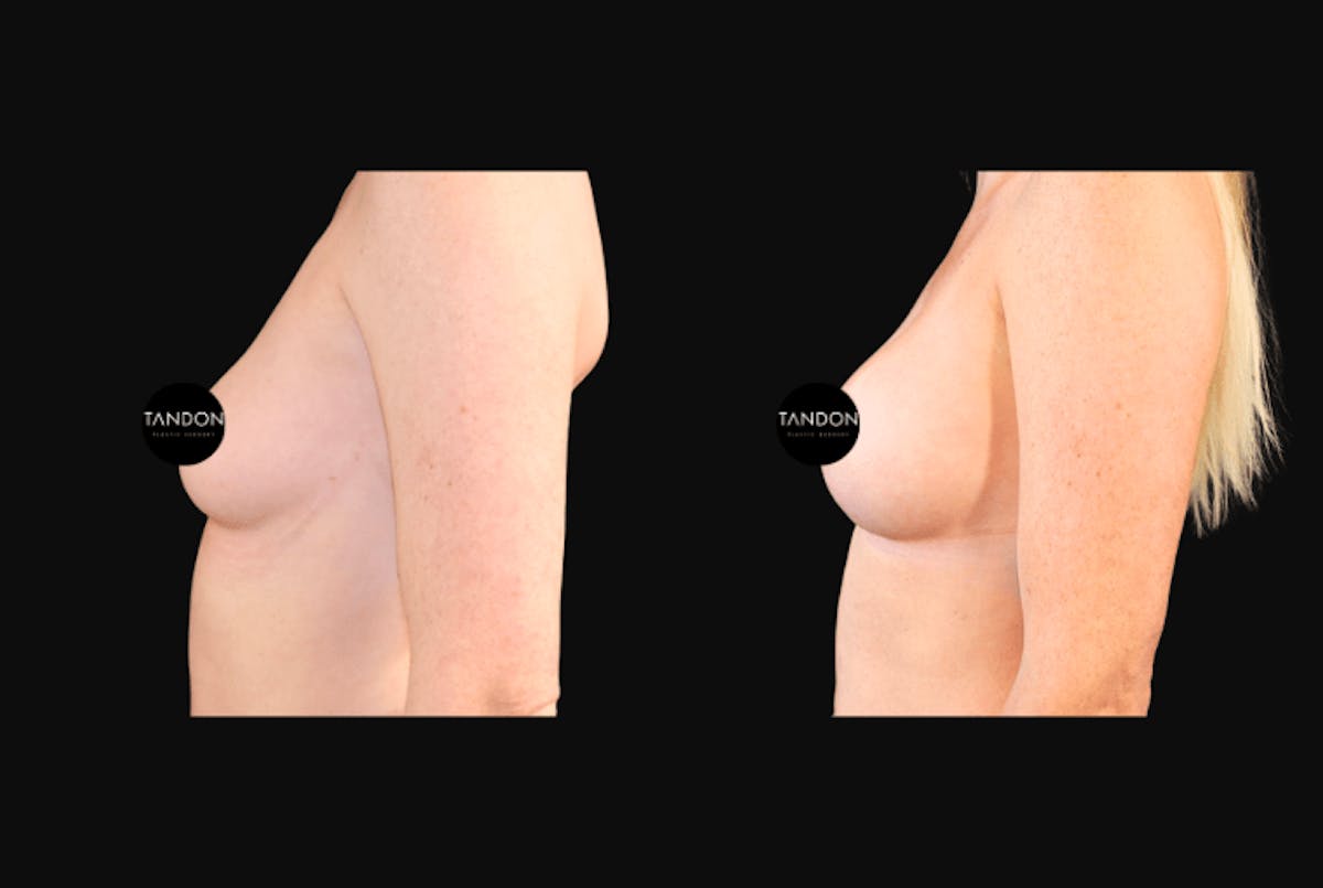 Breast Augmentation  Before & After Gallery - Patient 318027 - Image 5
