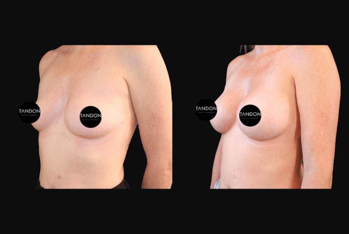 Breast Augmentation  Before & After Gallery - Patient 318027 - Image 4