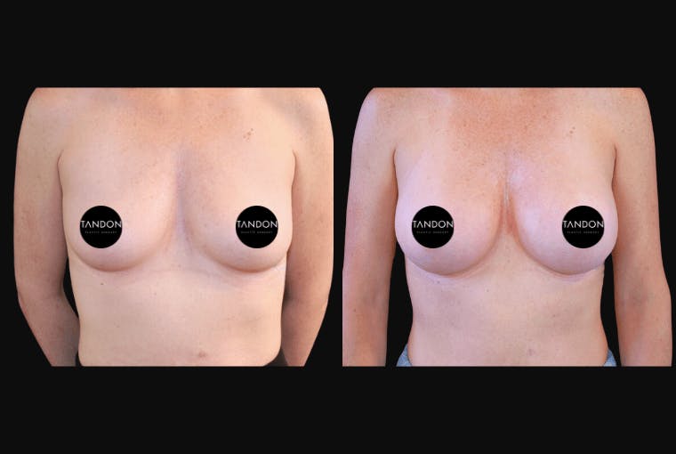 Breast Augmentation Before & After Gallery - Patient 318027 - Image 1