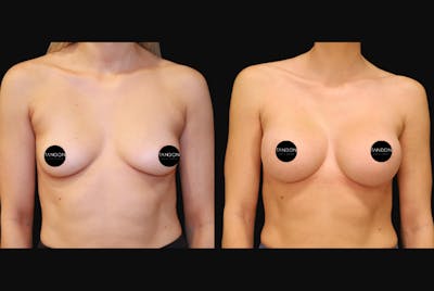 Breast Augmentation Before & After Gallery - Patient 397520 - Image 1