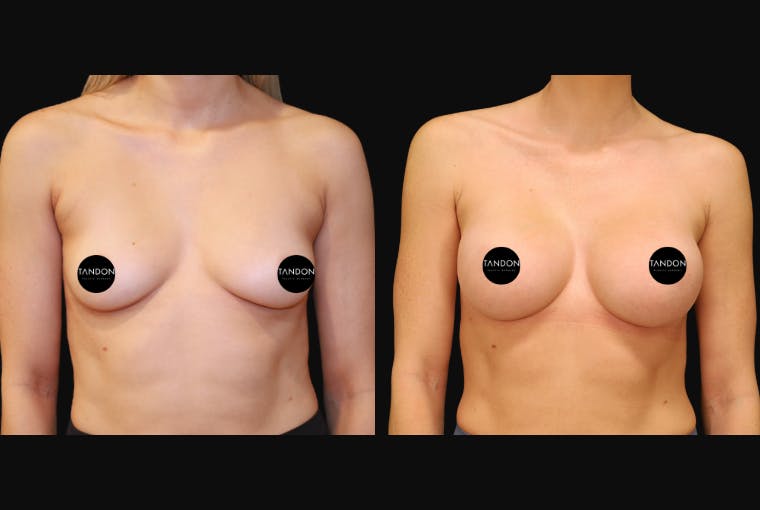 Breast Augmentation Before & After Gallery - Patient 397520 - Image 1
