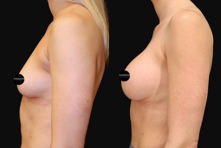 Breast Augmentation Before & After Gallery - Patient 397520 - Image 5