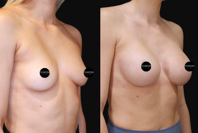 Breast Augmentation Before & After Gallery - Patient 397520 - Image 2