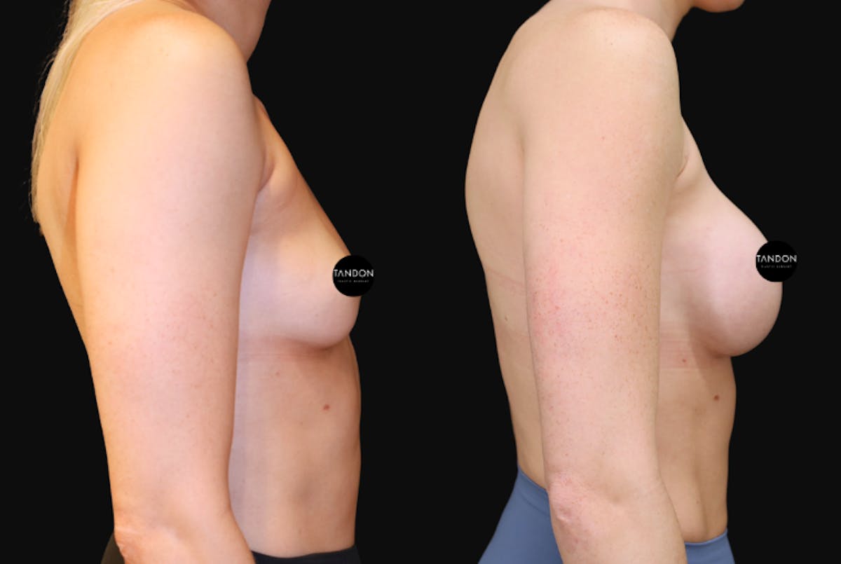 Breast Augmentation  Before & After Gallery - Patient 397520 - Image 3