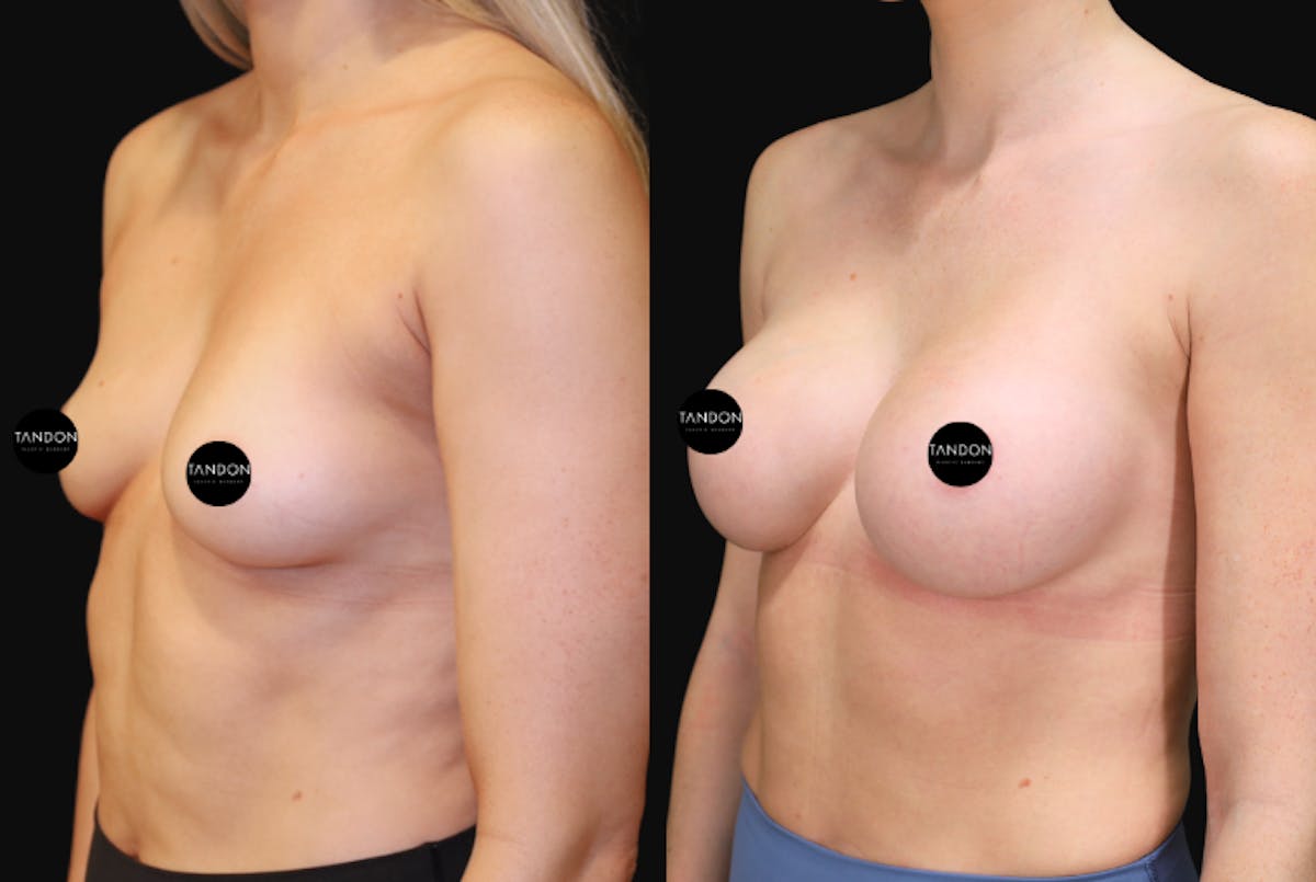 Breast Augmentation  Before & After Gallery - Patient 397520 - Image 4