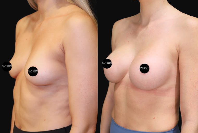 Breast Augmentation Before & After Gallery - Patient 397520 - Image 4