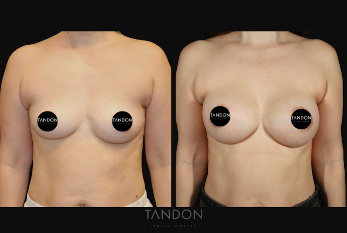 Breast Augmentation  Before & After Gallery - Patient 256104 - Image 1