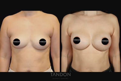 Breast Augmentation Before & After Gallery - Patient 256104 - Image 1
