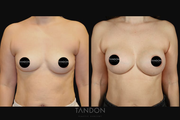 Breast Augmentation Before & After Gallery - Patient 256104 - Image 1