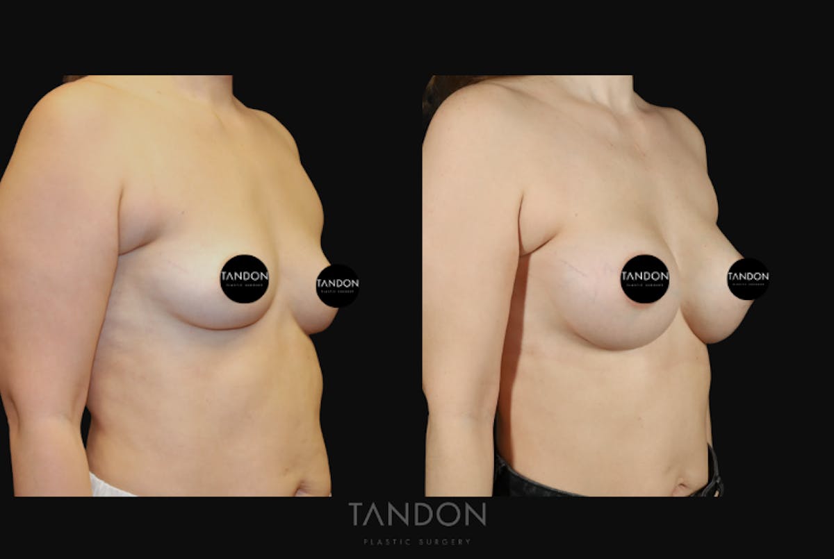 Breast Augmentation  Before & After Gallery - Patient 256104 - Image 2