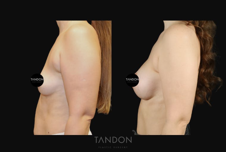 Breast Augmentation Before & After Gallery - Patient 256104 - Image 3
