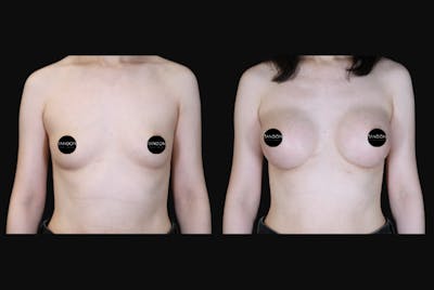 Breast Augmentation Before & After Gallery - Patient 350635 - Image 1