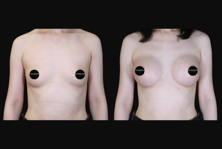 Breast Augmentation Before & After Gallery - Patient 350635 - Image 1