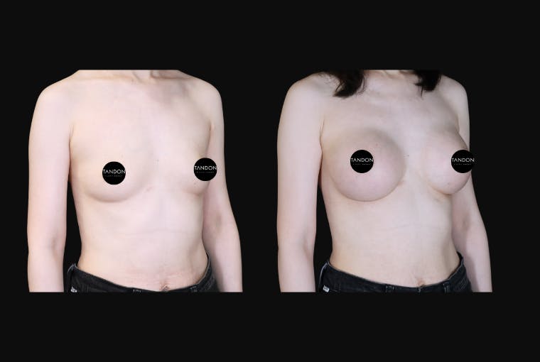 Breast Augmentation Before & After Gallery - Patient 350635 - Image 2