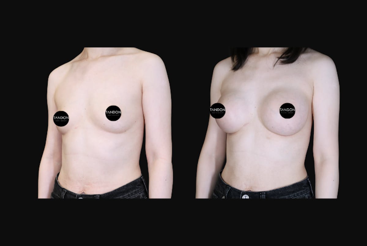 Breast Augmentation  Before & After Gallery - Patient 350635 - Image 4
