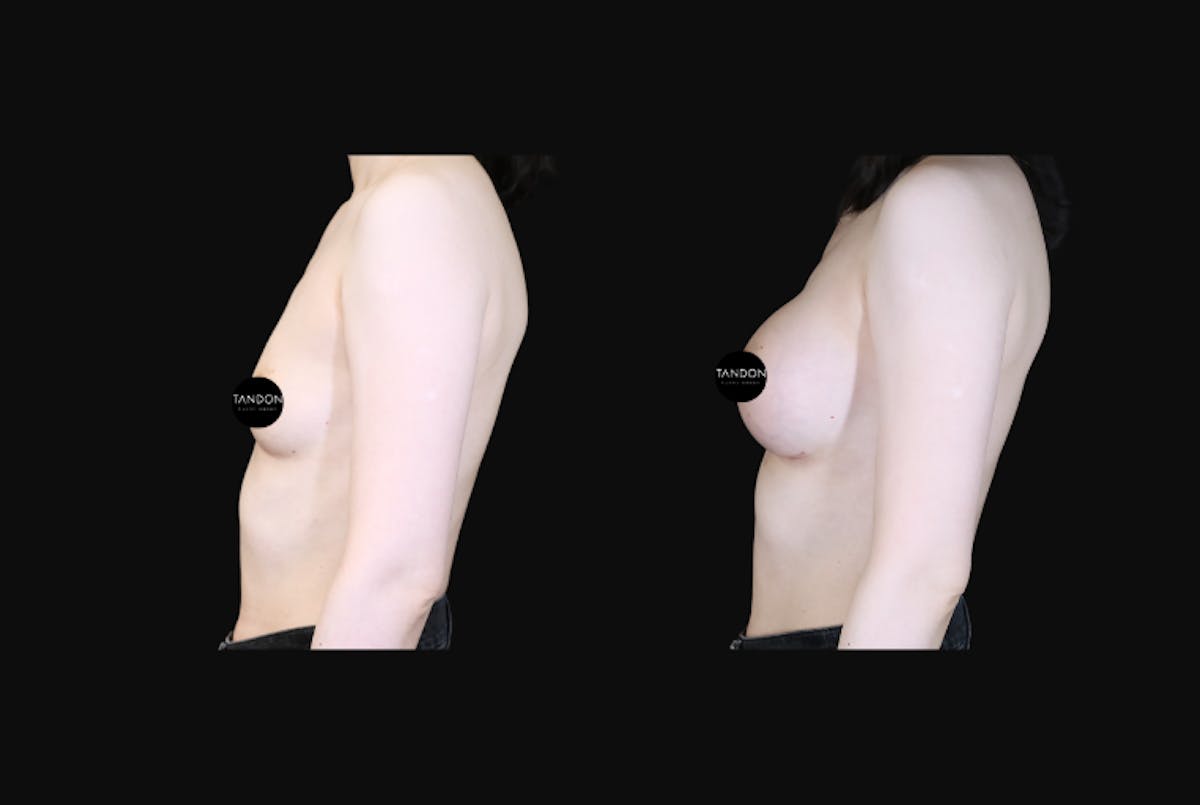 Breast Augmentation  Before & After Gallery - Patient 350635 - Image 3