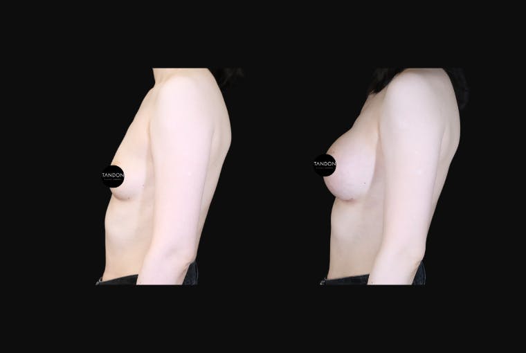 Breast Augmentation Before & After Gallery - Patient 350635 - Image 3