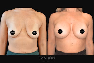 Breast Augmentation Before & After Gallery - Patient 377495 - Image 1