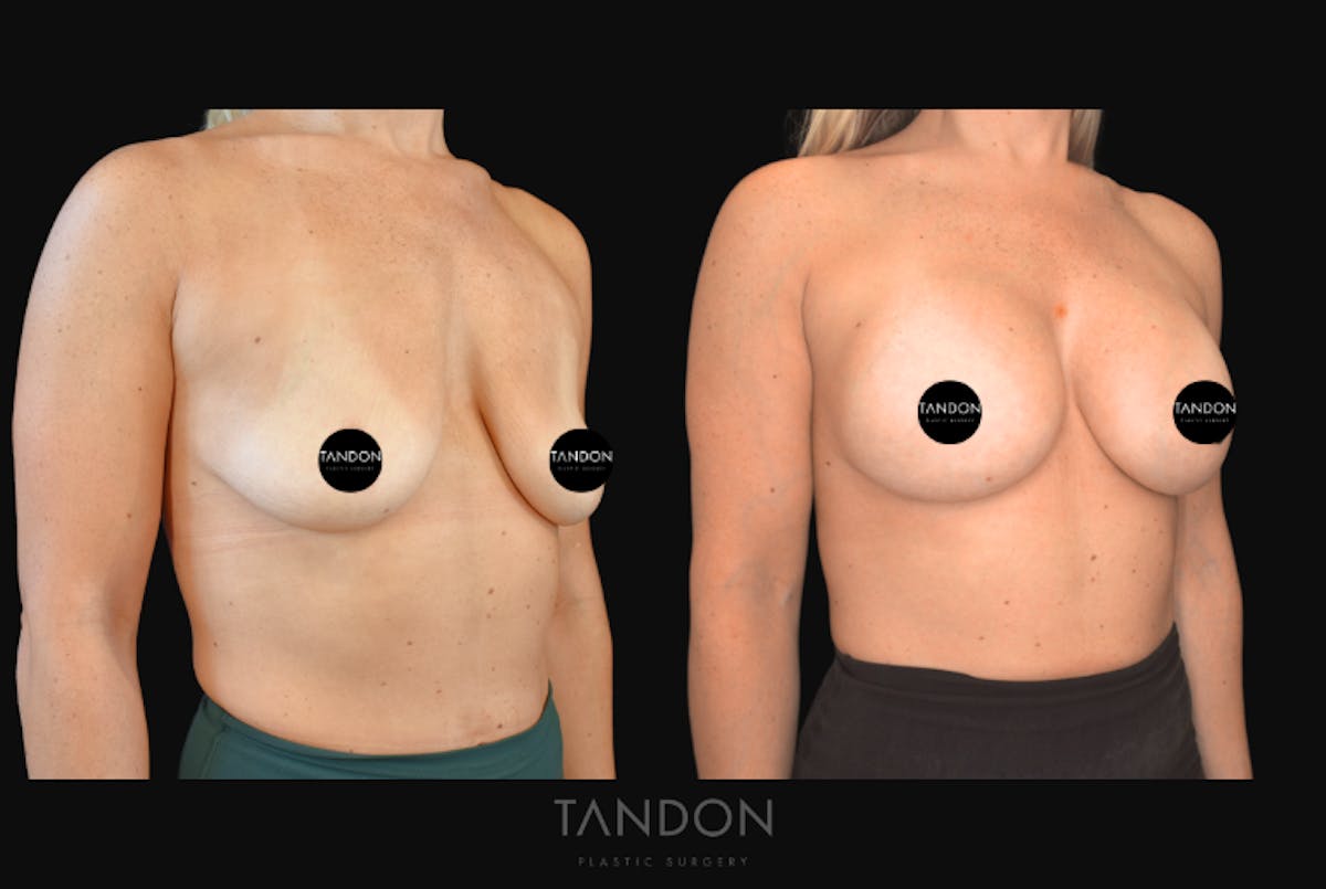Breast Augmentation  Before & After Gallery - Patient 377495 - Image 2